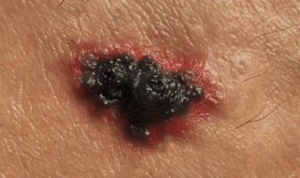 melanoma