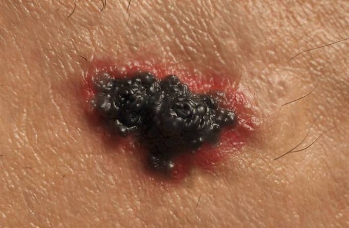 melanoma