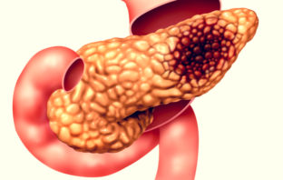 tumore pancreas