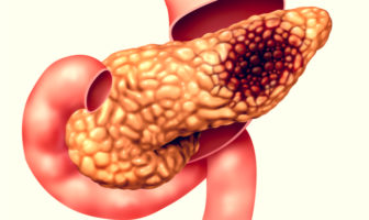 tumore pancreas