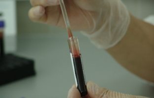 Giornata Malato, IFO: non ci siamo mai fermati e abbiamo aumentato la presa in carico dei pazienti malato oncologico
