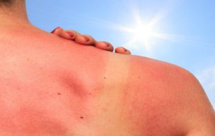 Scottature, come prevenirle con una corretta idratazione scottature