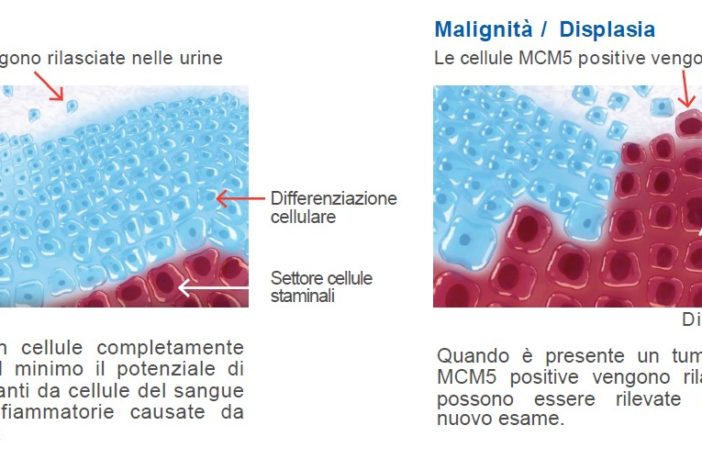 tumore vescica