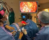IRE: prima mastectomia con tecnica endoscopica in struttura pubblica Lazio