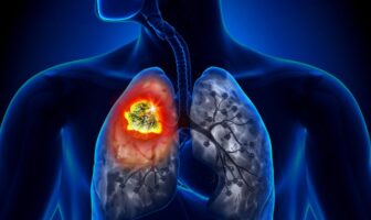 Tumore polmone: scoperta mutazione “amica” dell’immunoterapia tumore polmone